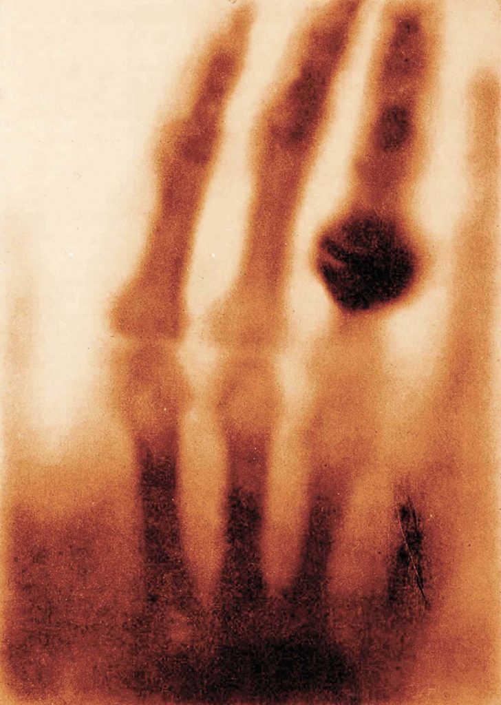 دست خانم ویلهلم رانتگن - اولین عکس با ایکس ری